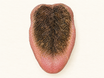 A human tongue shows a dark, fuzzy coating on the middle and back of its upper surface caused by elongated papillae trapping debris, while the tip and sides remain pink and healthy.